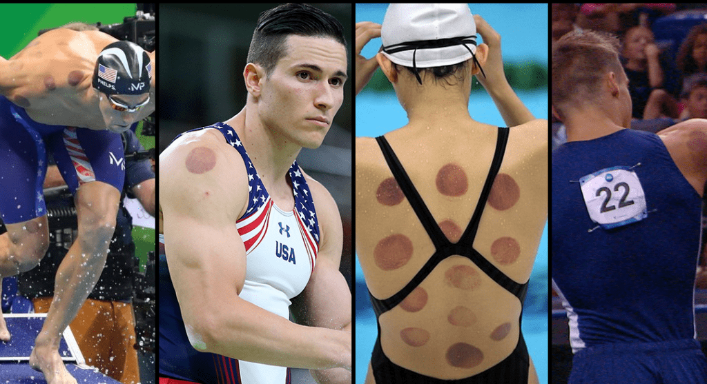 cupping spotted on athlete's body